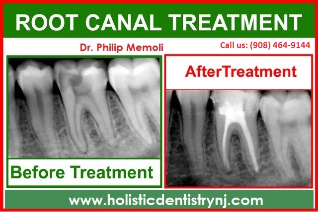 root-canal-treatment-alternative-nj